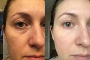 Before and after results at day 30
