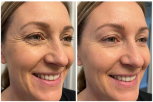Before and after results using BioLift NAD+ Peptide Serum